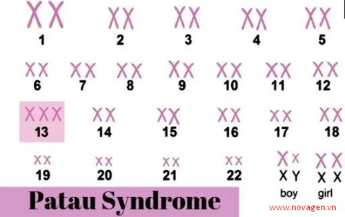 Hội chứng Patau (Trisomy 13)